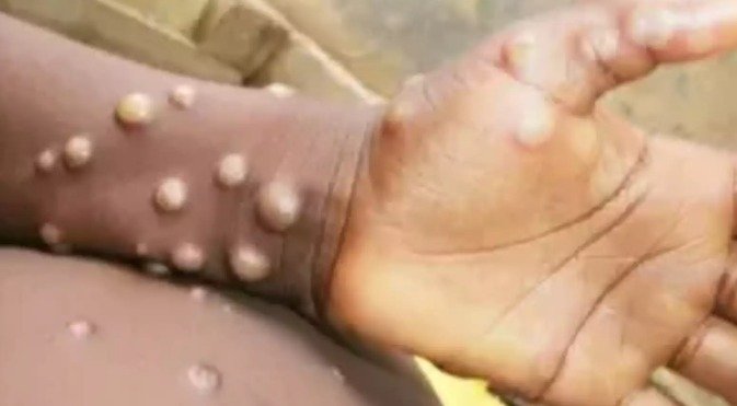 ਕਰਨਾਟਕ ਵਿੱਚ ਮੰਕੀਪੌਕਸ ਦਾ ਪਹਿਲਾ ਮਾਮਲਾ ਸਾਹਮਣੇ ਆਇਆ: ਸਿਹਤ ਵਿਭਾਗ ਹਾਈ ਅਲਰਟ ‘ਤੇ
