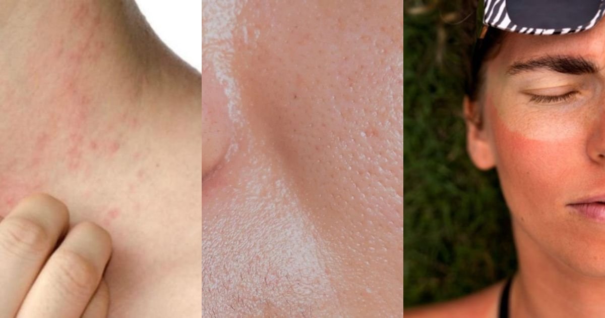 Health Special ; ਗਰਮੀਆਂ ‘ਚ ਚਮੜੀ ਦੇ ਇਨ੍ਹਾਂ ਰੋਗਾਂ ਦਾ ਖਤਰਾ, ਜਾਣੋ ਡਾਕਟਰ ਤੋਂ ਦੇਖਭਾਲ ਦੇ ਤਰੀਕੇ