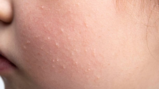 ਹੋਲੀ ਦੇ ਰੰਗਾਂ ਨਾਲ ਚਮੜੀ ਦੀ ਐਲਰਜੀ ਤੋਂ ਬਚਣ ਦੇ ਉਪਾਅ