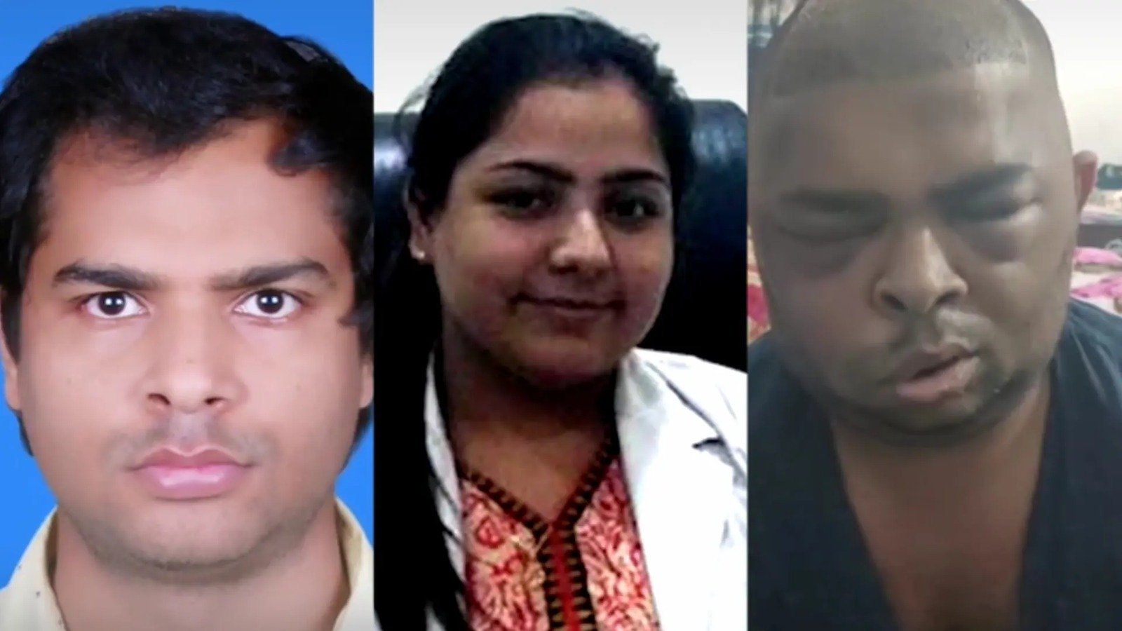 Uttar Pradesh ; ਵਾਲਾਂ ਦੇ ਟ੍ਰਾਂਸਪਲਾਂਟ ਨਾਲ ਇੱਕ ਹੋਰ ਮੌਤ, ਮਹਿਲਾ ਡਾਕਟਰ ਨੇ ਦੋਵਾਂ ਦੀ ਸੀ ਕੀਤੀ ਥੈਰੇਪੀ , ਹੁਣ ਫਰਾਰ