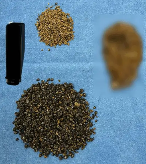 Haryana News: ਗੁਰੂਗ੍ਰਾਮ ਵਿੱਚ ਮਰੀਜ਼ ਦੇ ਪਿੱਤੇ ਦੀ ਥੈਲੀ ਵਿੱਚੋਂ 8125 ਪੱਥਰੀ ਕਢੀ: ਪੱਥਰੀਆਂ ਦੀ ਗਿਣਤੀ ਕਰਨ ਵਿੱਚ ਲੱਗੇ 6 ਘੰਟੇ