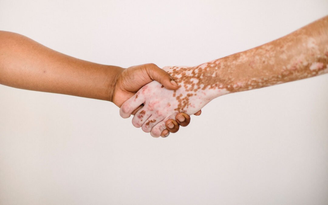 World Vitiligo Day 2025: ਕੀ ਇਹ ਬਿਮਾਰੀ ਛੂਹਣ ਨਾਲ ਹੁੰਦੀ ਹੈ? ਚਿੱਟੇ ਧੱਬੇ ਦੀ ਬਿਮਾਰੀ ਦਾ ਕਾਲਾ ਸੱਚ ਜਾਣੋ