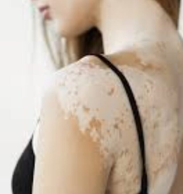 World Vitiligo Day 2025
