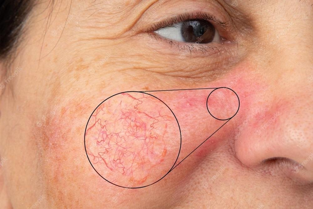 Skin Cancer: ਚਮੜੀ ਦਾ ਕੈਂਸਰ ਹੋਣ ‘ਤੇ ਸ਼ੁਰੂ ਵਿੱਚ ਇਹ ਦਿਖਾਈ ਦੇਣ ਲੱਗ ਪੈਂਦੇ ਹਨ ਲੱਛਣ , ਜਾਣੋ ਇਸਨੂੰ ਕਿਵੇਂ ਪਛਾਣਿਆ ਜਾਵੇ?